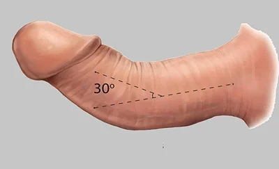 penis begradigen
